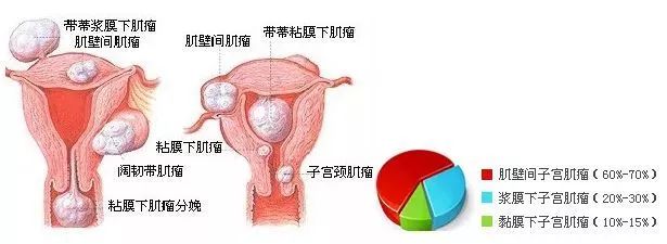 子宫肌瘤最新高效治疗策略